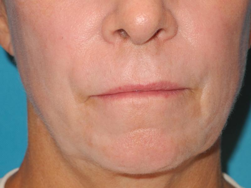 CO2 Laser Resurfacing case #4754