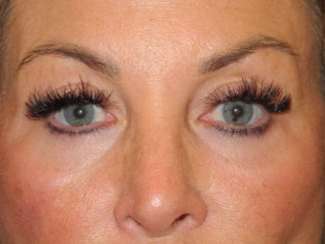 Blepharoplasty case #5252