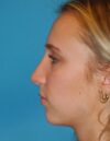 Rhinoplasty case #3523