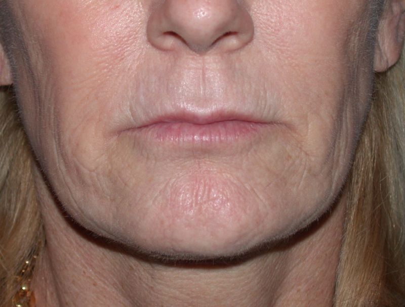 CO2 Laser Resurfacing case #4683