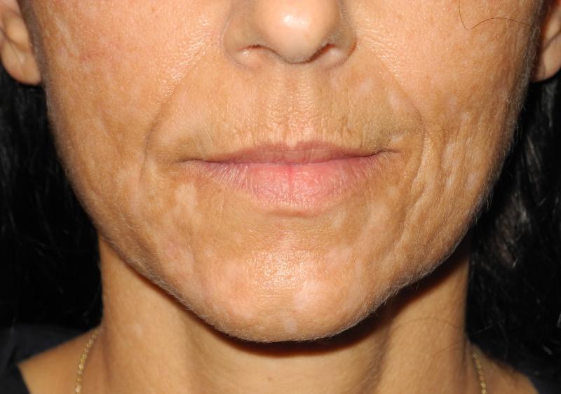 CO2 Laser Resurfacing case #4755