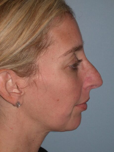 Rhinoplasty case #4166