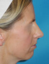 Chin Implant case #5640