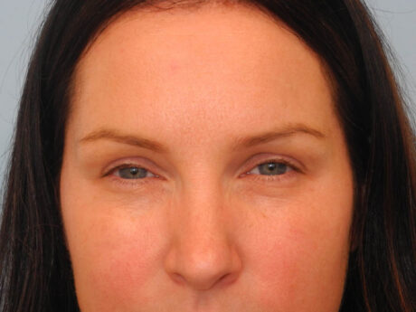 BOTOX® case #5611