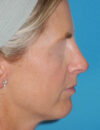 Chin Implant case #5640