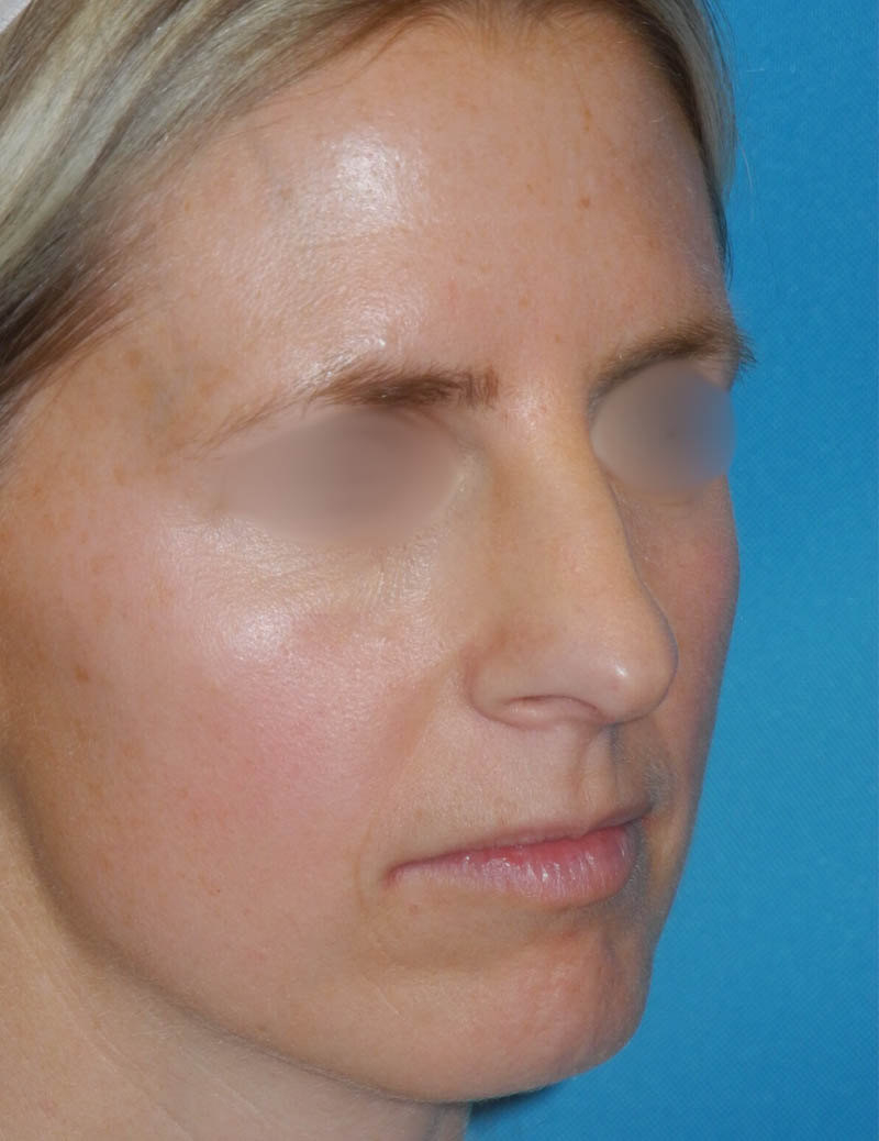 Chin Implant case #5640