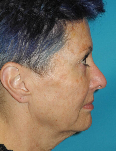 Facelift case #5645