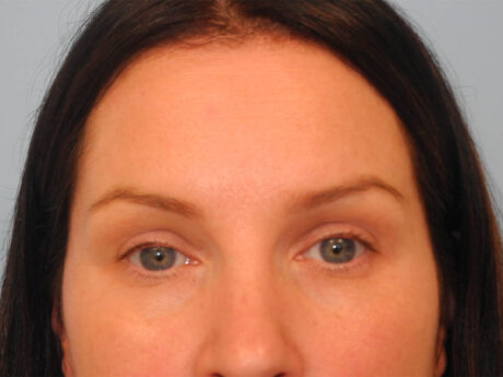 BOTOX® case #5611