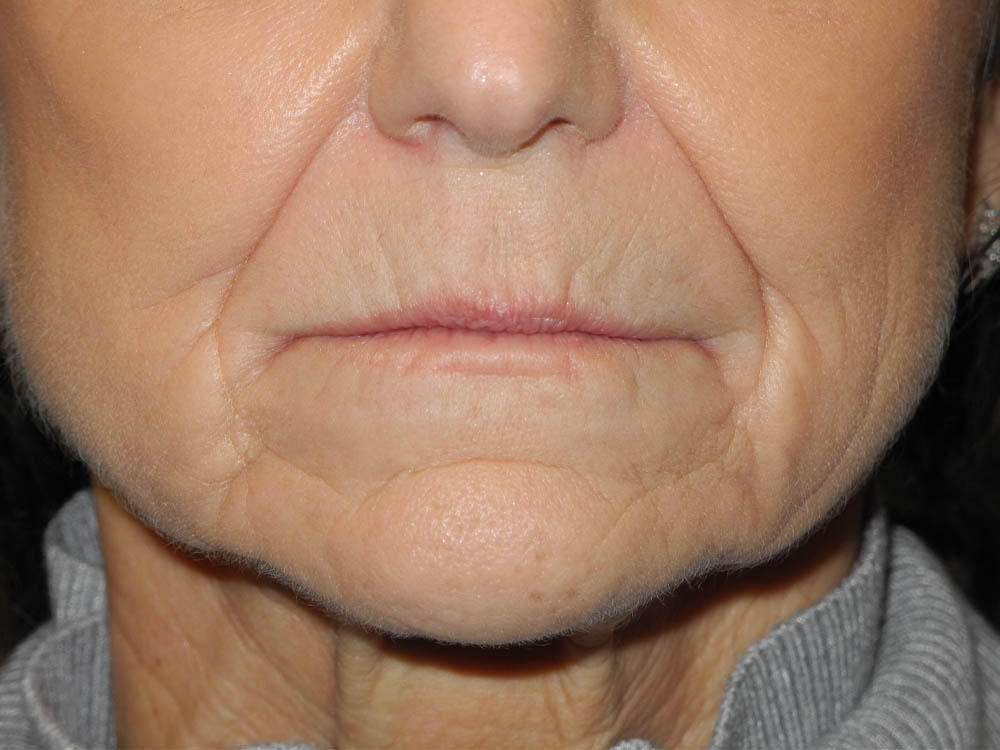 BOTOX® case #5630