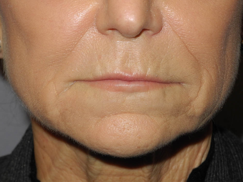 BOTOX® case #5630