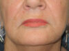 BOTOX® case #5625