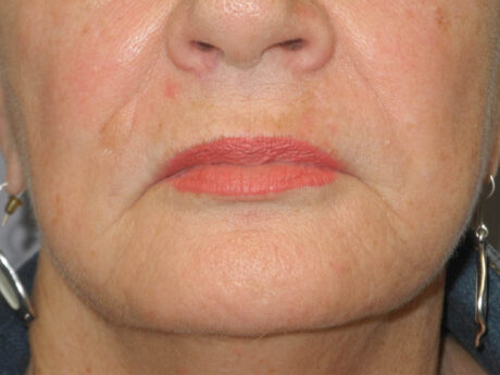 BOTOX® case #5625