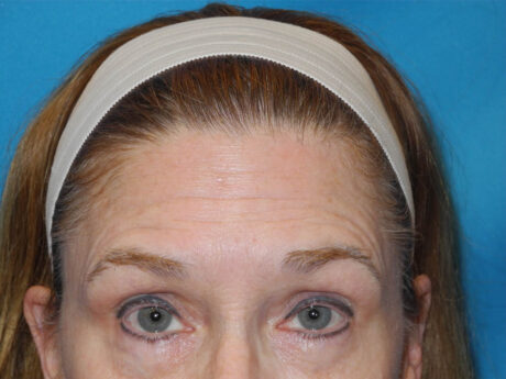 BOTOX® case #5637