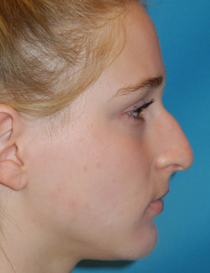 Rhinoplasty case #5662