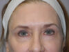 BOTOX® case #5637