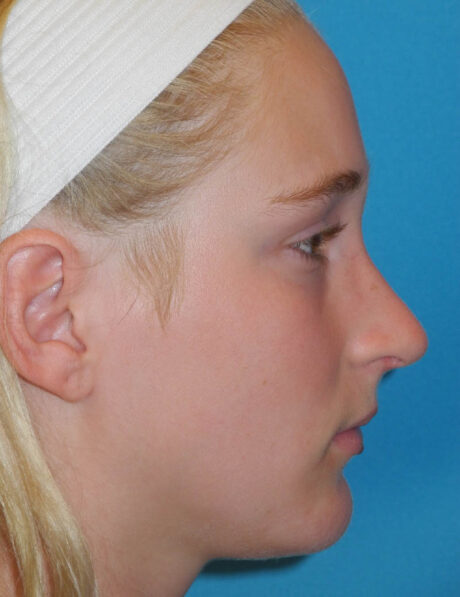 Rhinoplasty case #5662