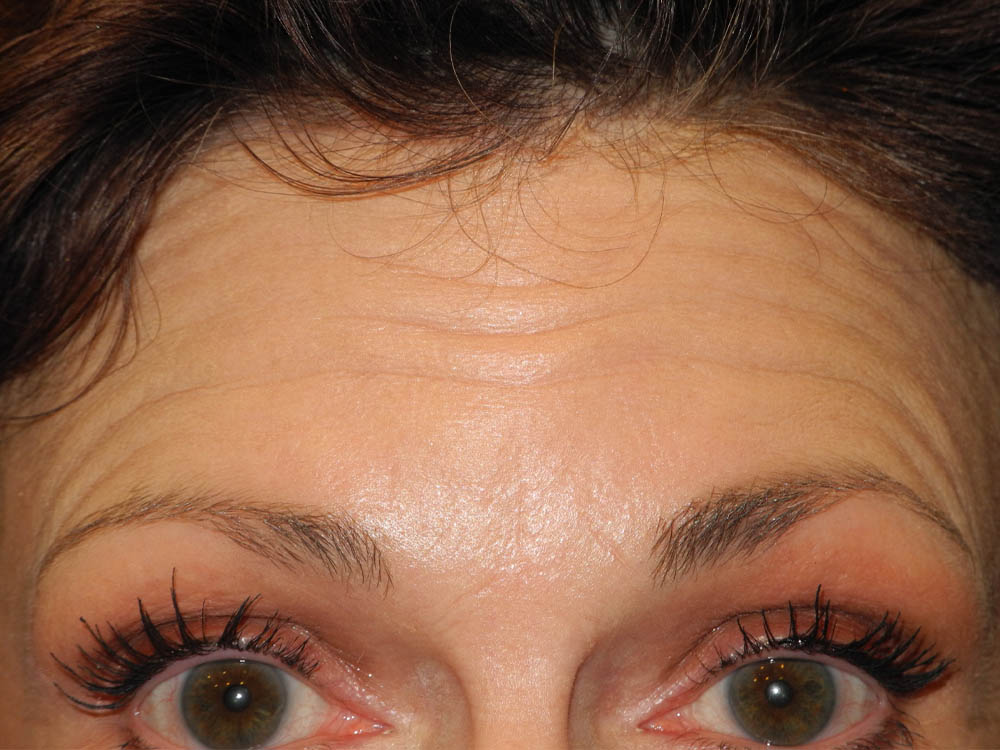 BOTOX® case #5630