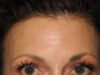 BOTOX® case #5630