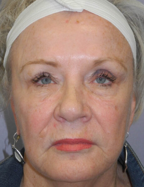 BOTOX® case #5625