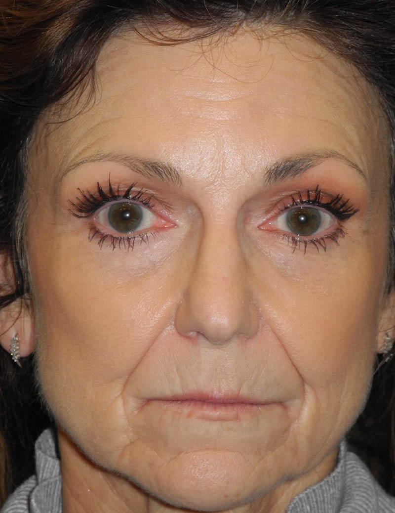 BOTOX® case #5630