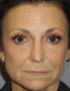 BOTOX® case #5630