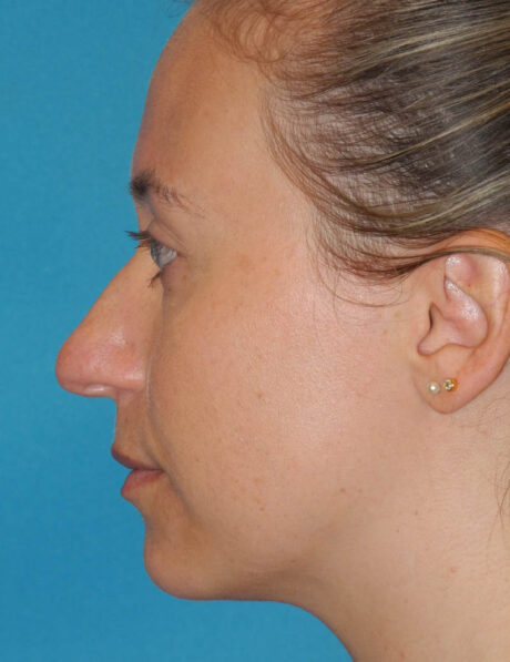 Rhinoplasty case #5669