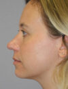 Rhinoplasty case #5669