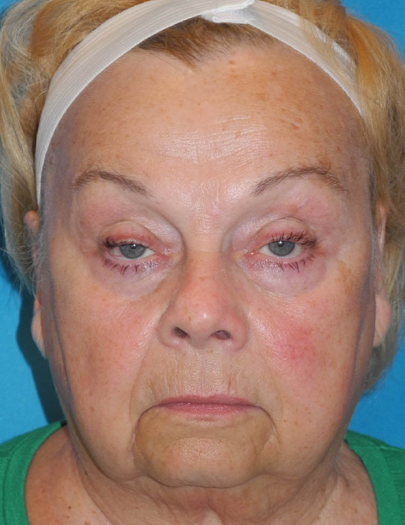 Blepharoplasty case #5676