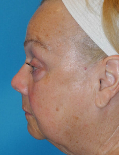 Blepharoplasty case #5676