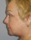 Blepharoplasty case #5676