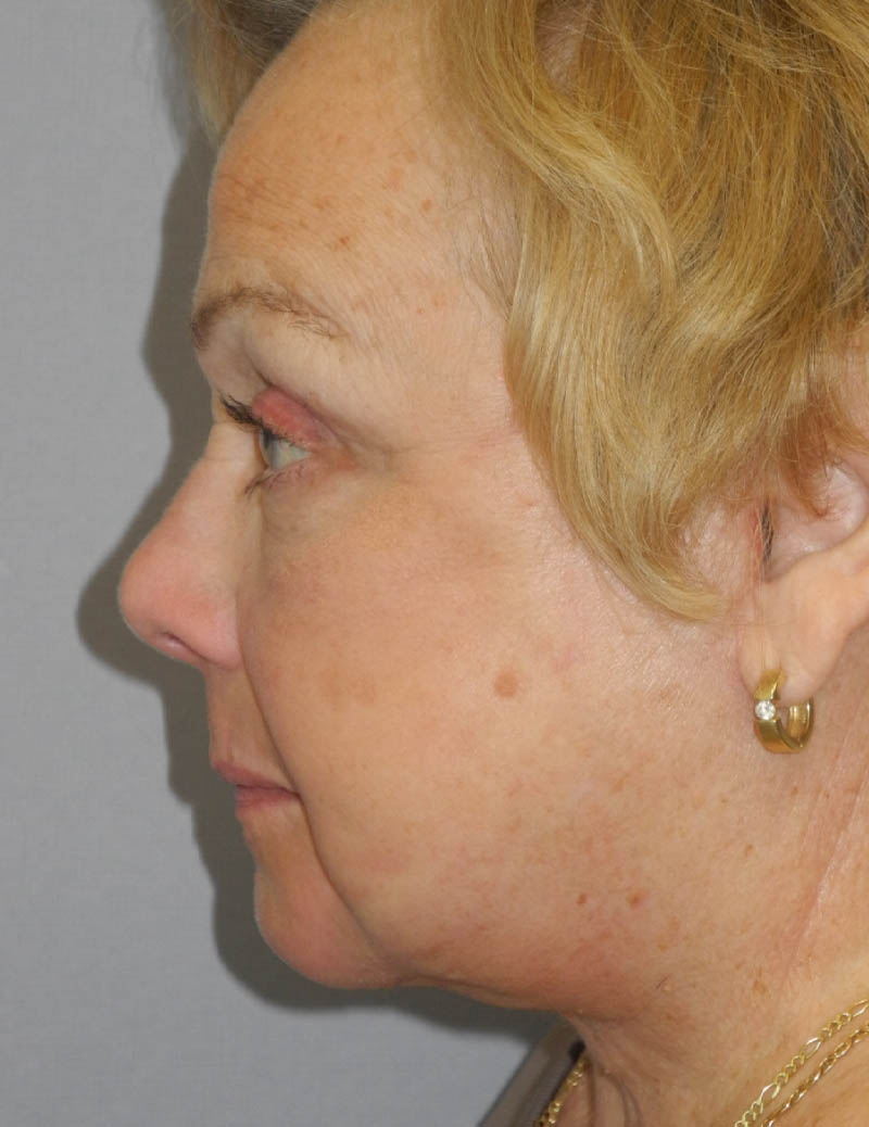 Blepharoplasty case #5676