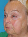 Blepharoplasty case #5676