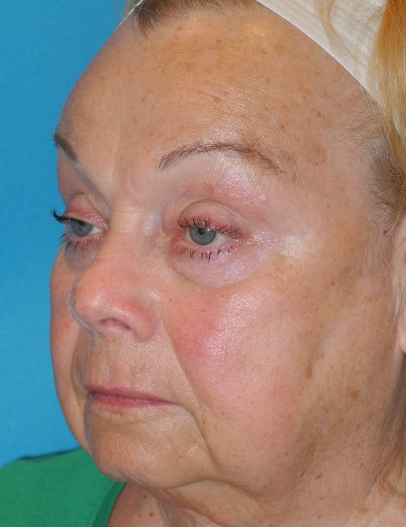 Blepharoplasty case #5676