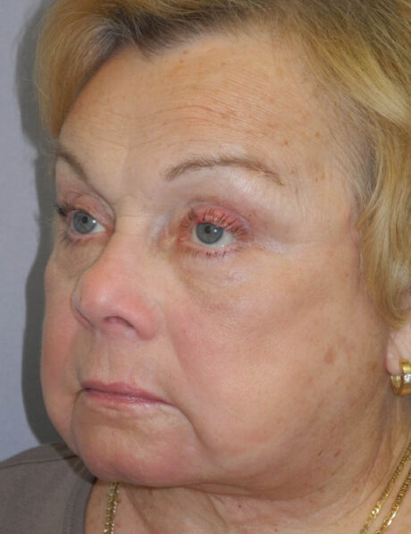 Blepharoplasty case #5676