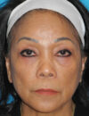 Blepharoplasty case #5683