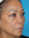 Blepharoplasty case #5683