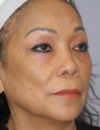 Blepharoplasty case #5683