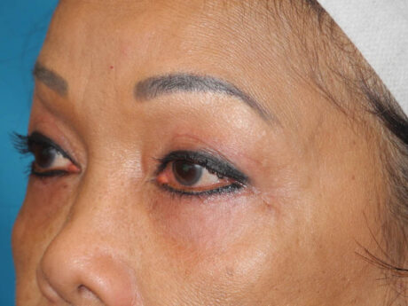 Blepharoplasty case #5683