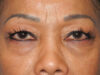 Blepharoplasty case #5683