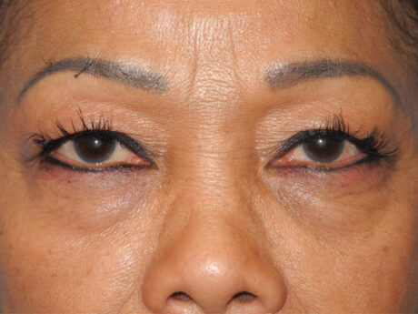 Blepharoplasty case #5683