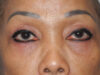 Blepharoplasty case #5683