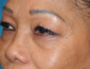 Blepharoplasty case #6463