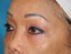 Blepharoplasty case #5683