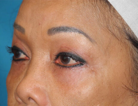 Blepharoplasty case #6463