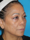 Blepharoplasty case #5683