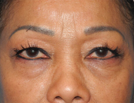 Blepharoplasty case #6463