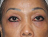 Blepharoplasty case #6463