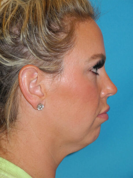 Chin Implant case #5885