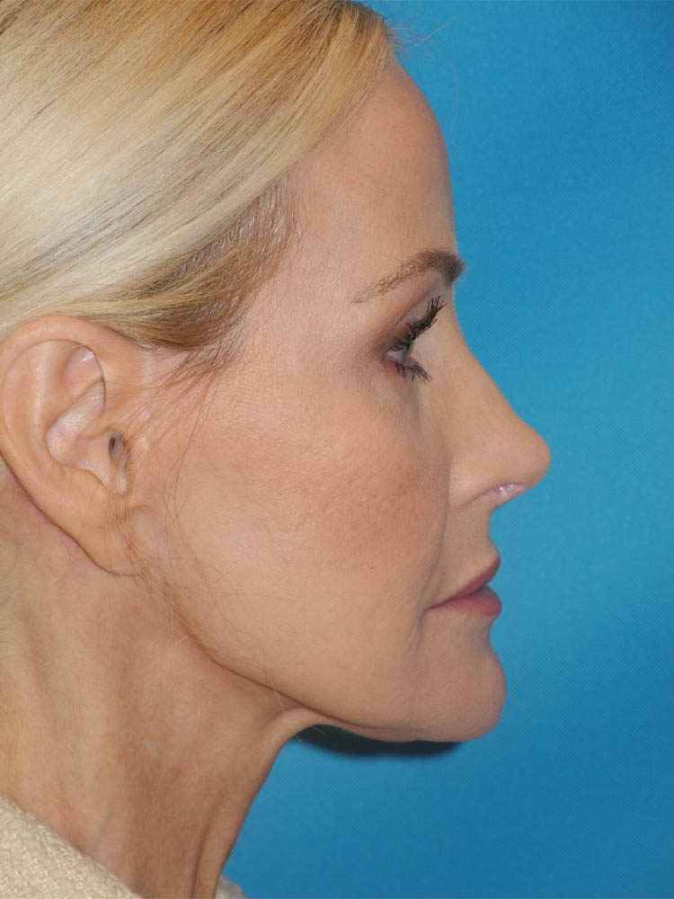 Rhinoplasty case #5910