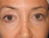 Blepharoplasty case #5901